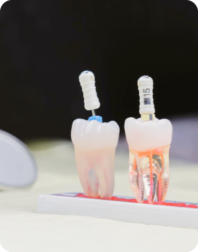conseils-traitement-racine-dentiste-archident Conseils après un traitement de racine  Drs Rhein, Rose & Hammami | Chirurgiens-dentistes Strasbourg