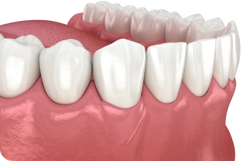 gencives-traitement-strasbourg-archident La greffe de gencive Parodontologie Drs Rhein, Rose & Hammami | Chirurgiens-dentistes Strasbourg