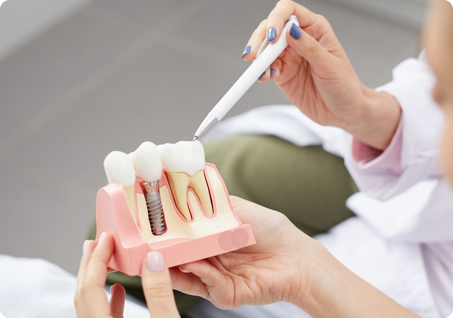 Remplacer une dent avec un implant
